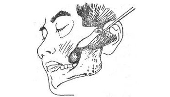 为牙源性感染,如下颌第三磨牙冠周炎,根尖周炎,等及扁桃体炎,涎腺炎